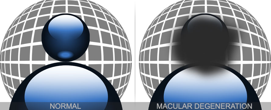 Visual example of Macular Degeneration